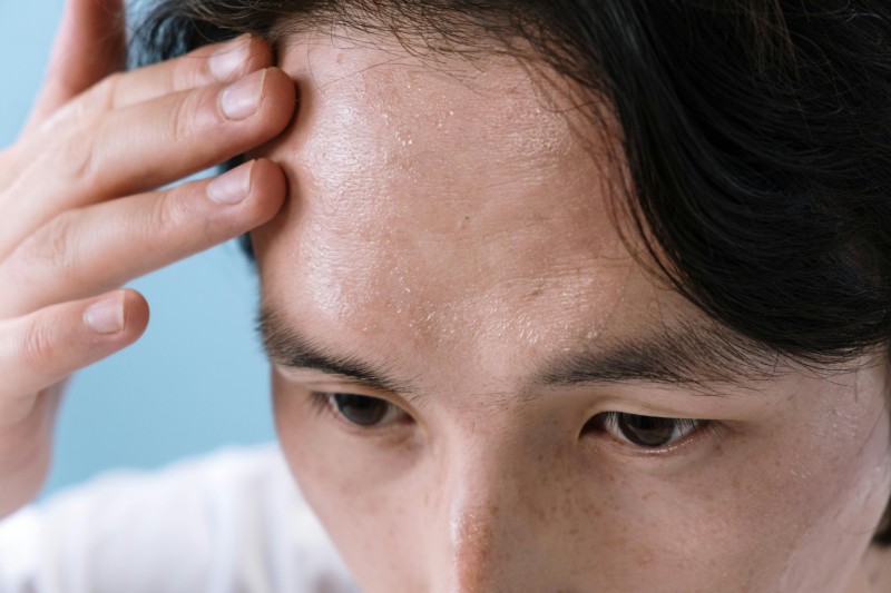 Man with a sweaty forehead getting treatment for hyperhidrosis